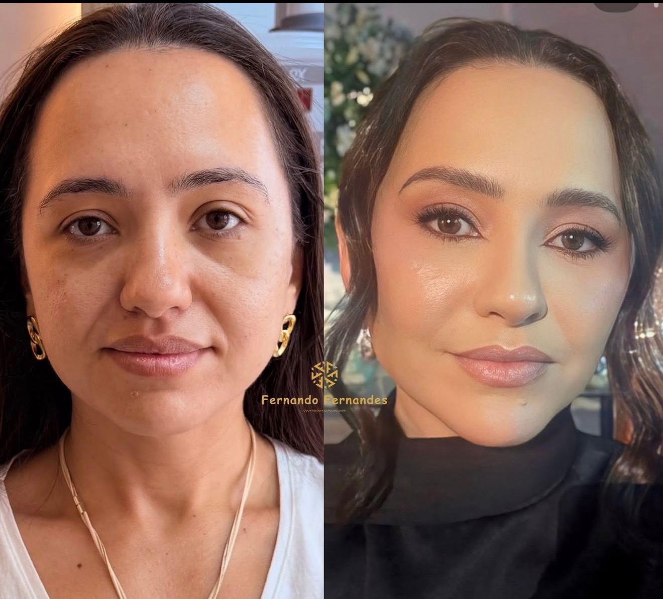 Resultado Harmonização Facial — Antes e Depois